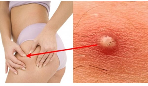 How to drain a boil at home. How To Treat A Boil At Home On Face Buttocks And Armpits