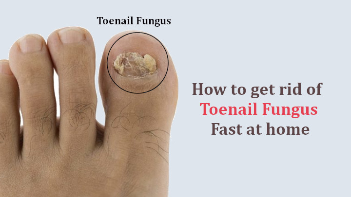 How To Get Rid Toenail Fungus Fast Share News About Nail