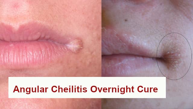 Angular Cheilitis Overnight Cure with Home remedy Must Try it