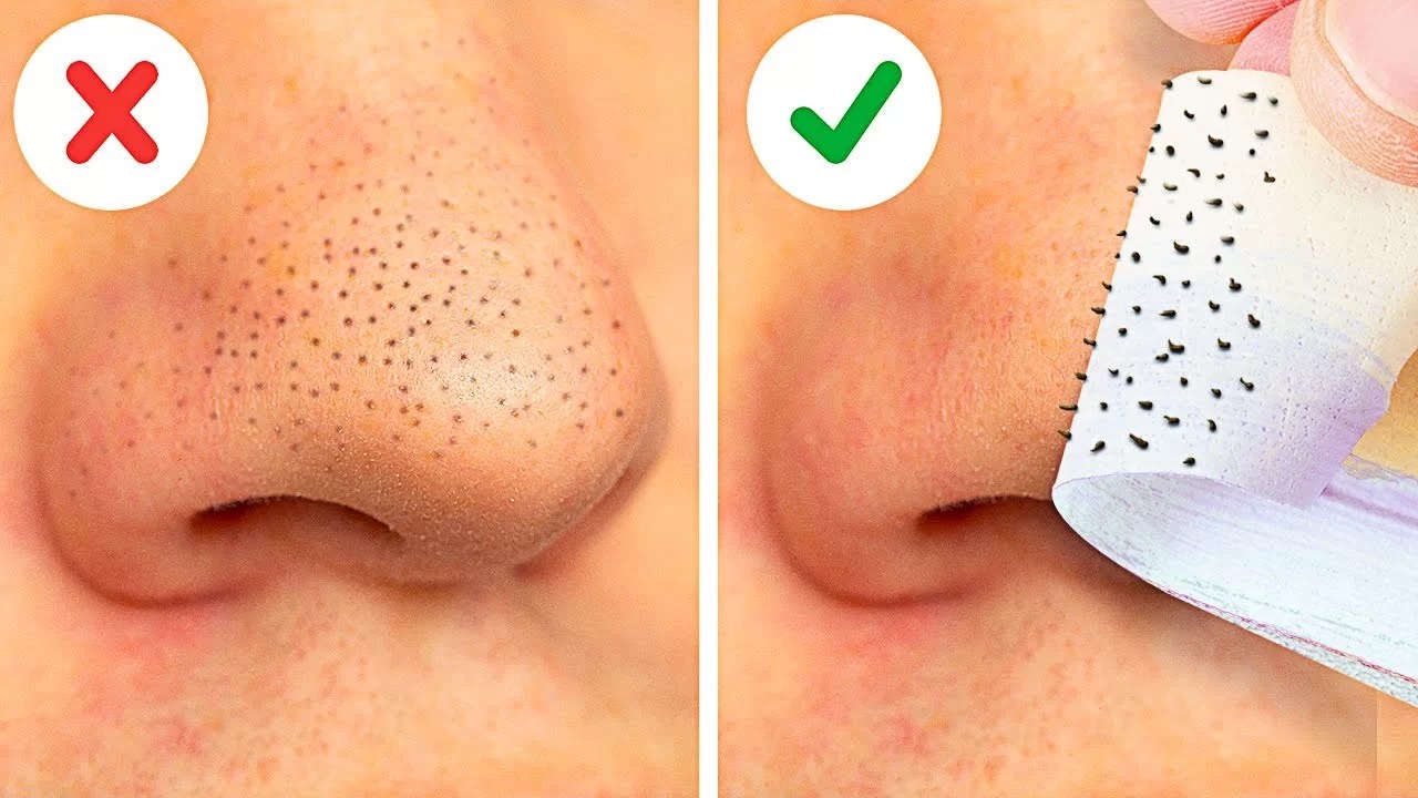 How to remove blackheads RightQuotes4all(05)