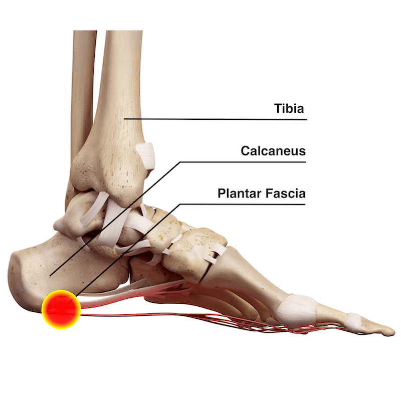 Plantar Fascia Tear What It Is And How To Treat It Riixo Recovery