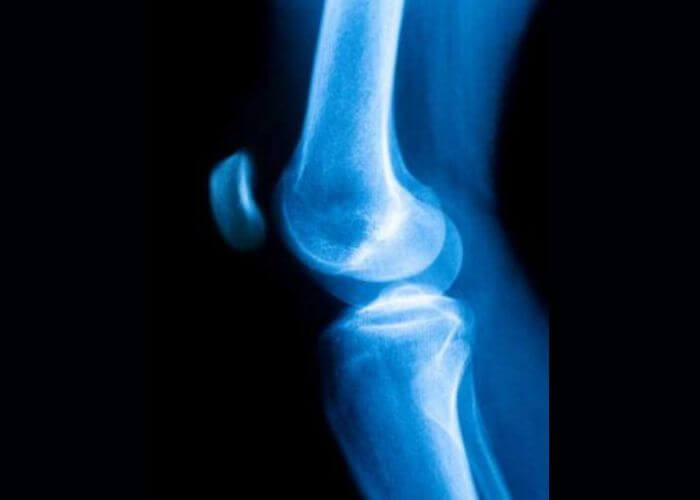 Patellar Chondral Defect Lesion Kneecap Cartilage Injury