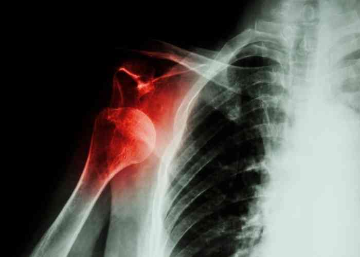 Shoulder Dislocation Subluxation Shoulder Instability Orthopedic