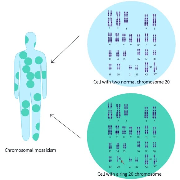 Karyotype Explanation Tool Ring20 Research and Support UK CIO