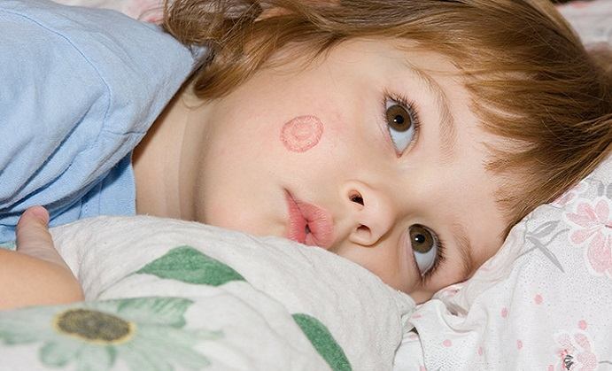 Tinea in Kids