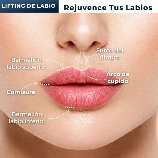 Lifting De Labios En Veracruz Dr. Rafael Revilla