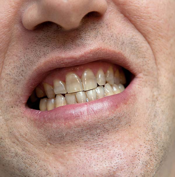 Stained or Discolored Teeth River Dental
