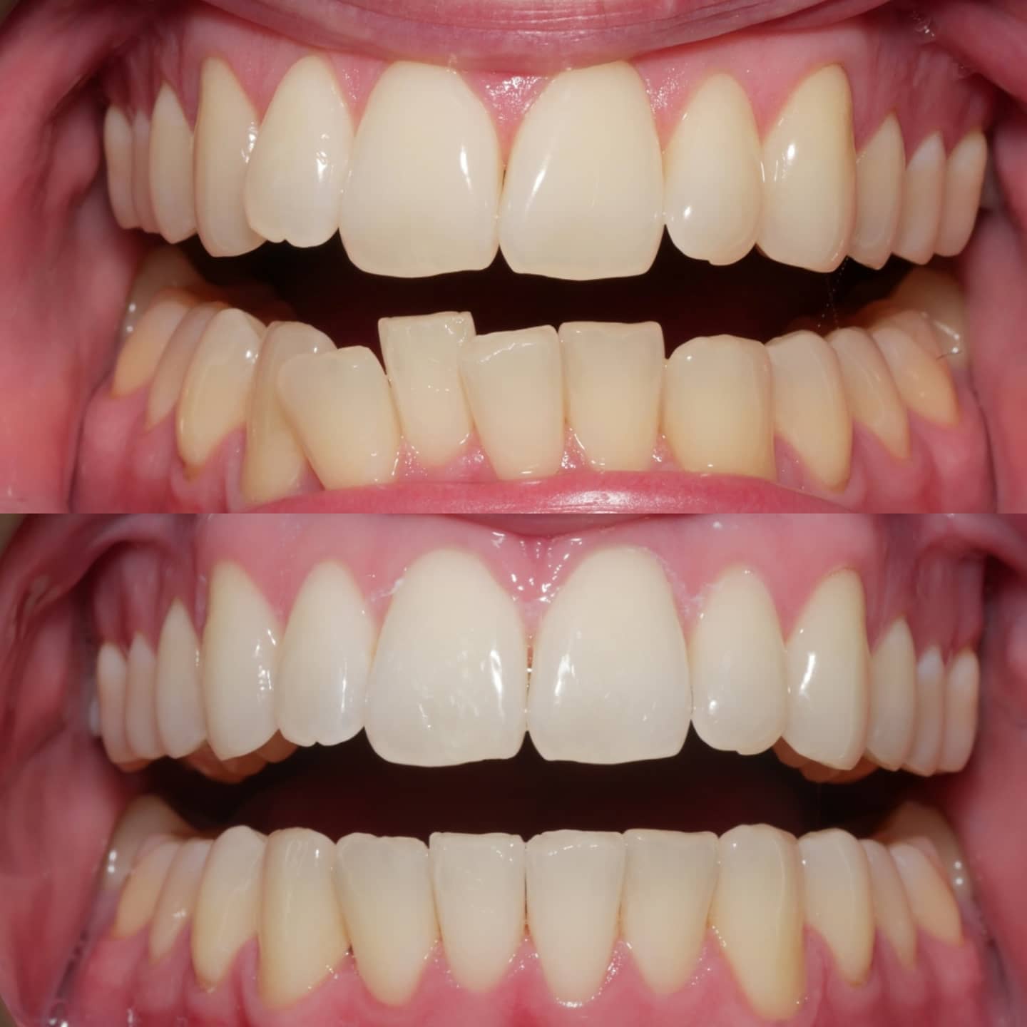 SureSmile & Invisalign Clear Aligners River District Dentistry