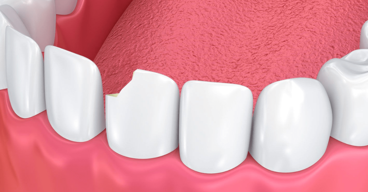 What Makes My Teeth Susceptible to Chipping?