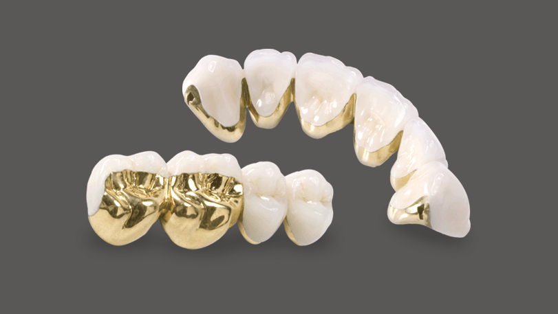 OcclusalGold Riverside Dental Ceramics FullCast Crowns