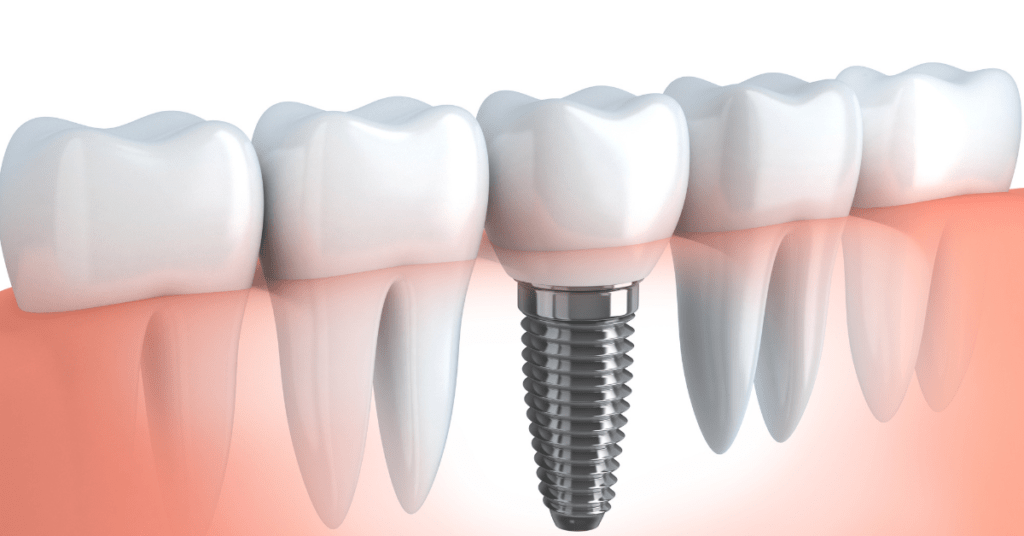 Facts About Dental Implant Recovery Process River Valley Smiles