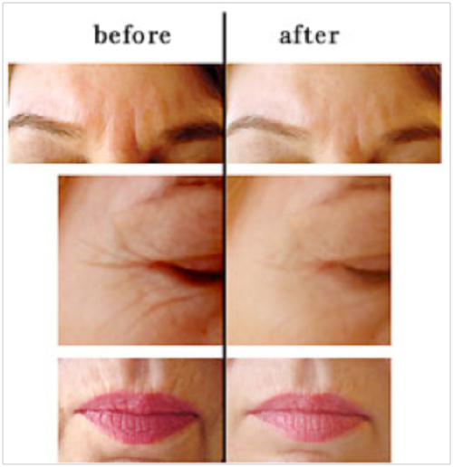 Cosmetic/Facelift Acupuncture Riverview Vitality Centre