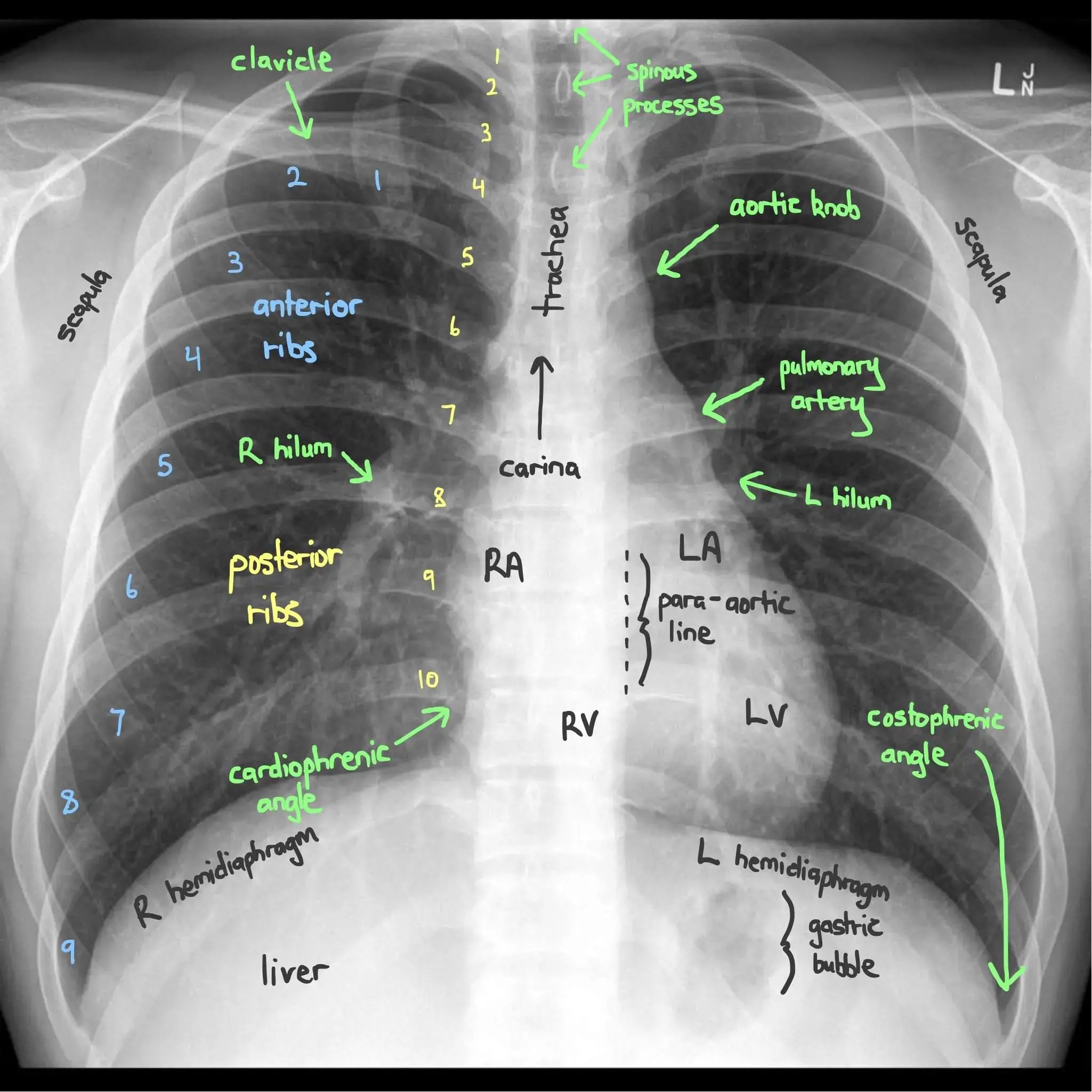 Reading Chest XRays RK.MD
