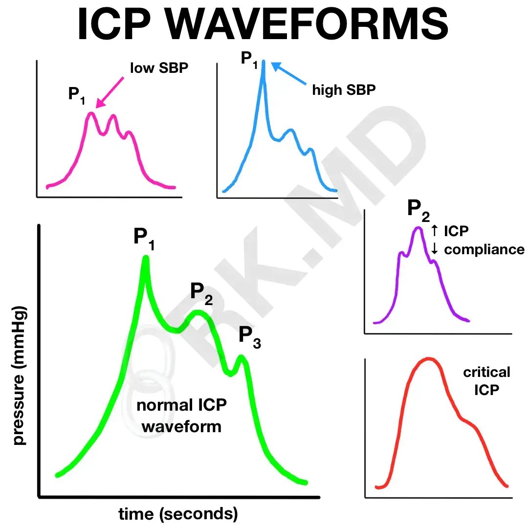 Measuring And Interpreting Intracranial Pressure (ICP) Waveforms RK.MD