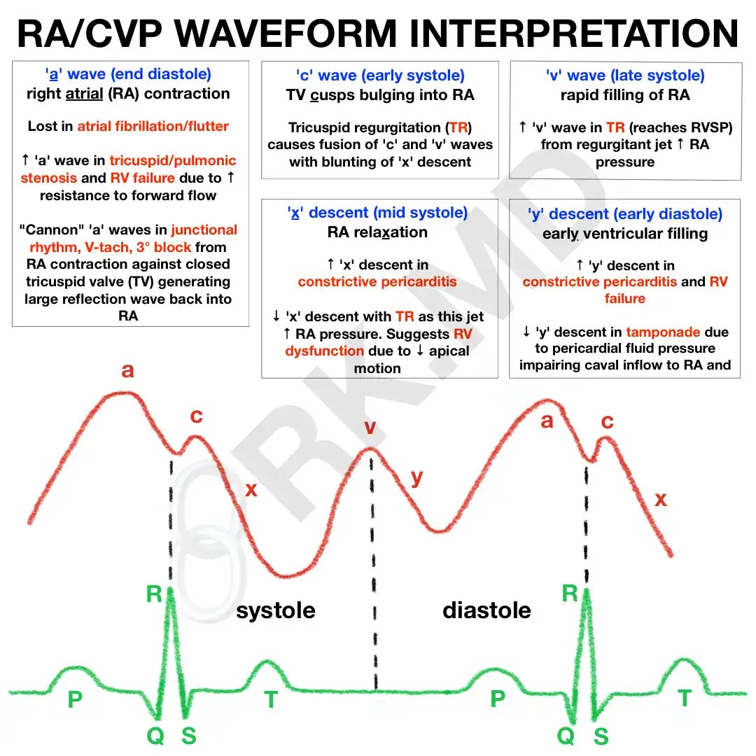 RA/CVP Waveform Interpretation RK.MD