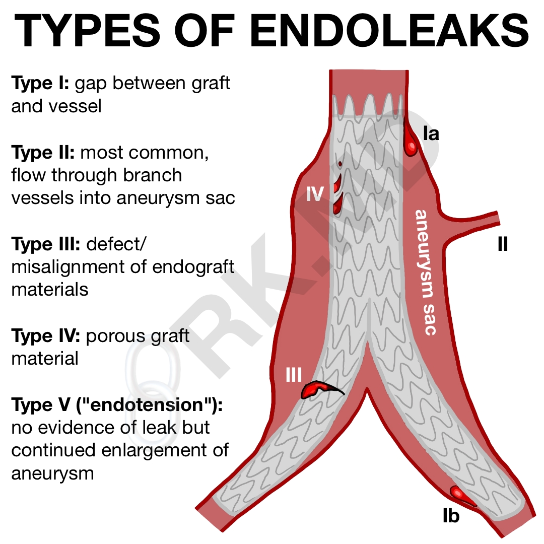 How To Do An Endo at JENENGE blog