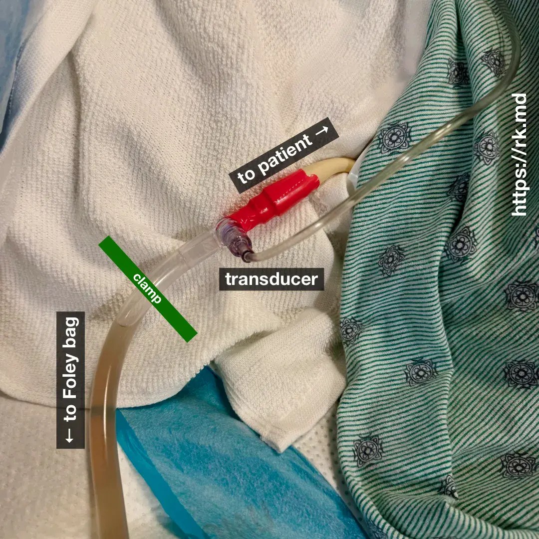 Estimating Intraabdominal Pressure With Bladder Pressure RK.MD