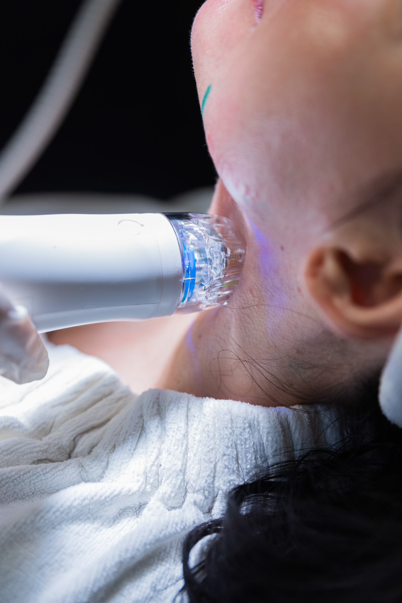 SecretRF Is Your Secret Weapon Against Aging Ritacca Cosmetic Surgery