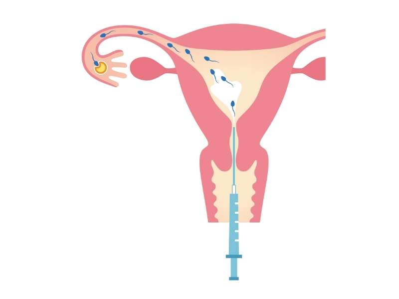 Absolutely Everything You Need to Know About IUI RMA Network Your