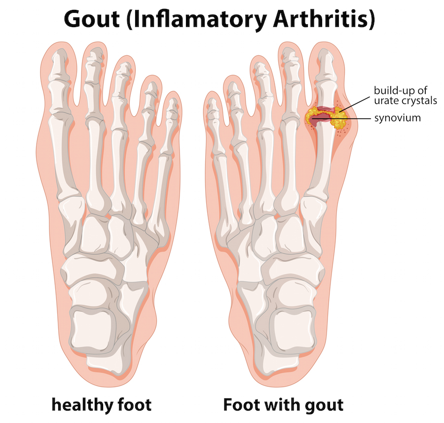 Foot Gout Treatment in Frisco, Tx RNV Podiatry