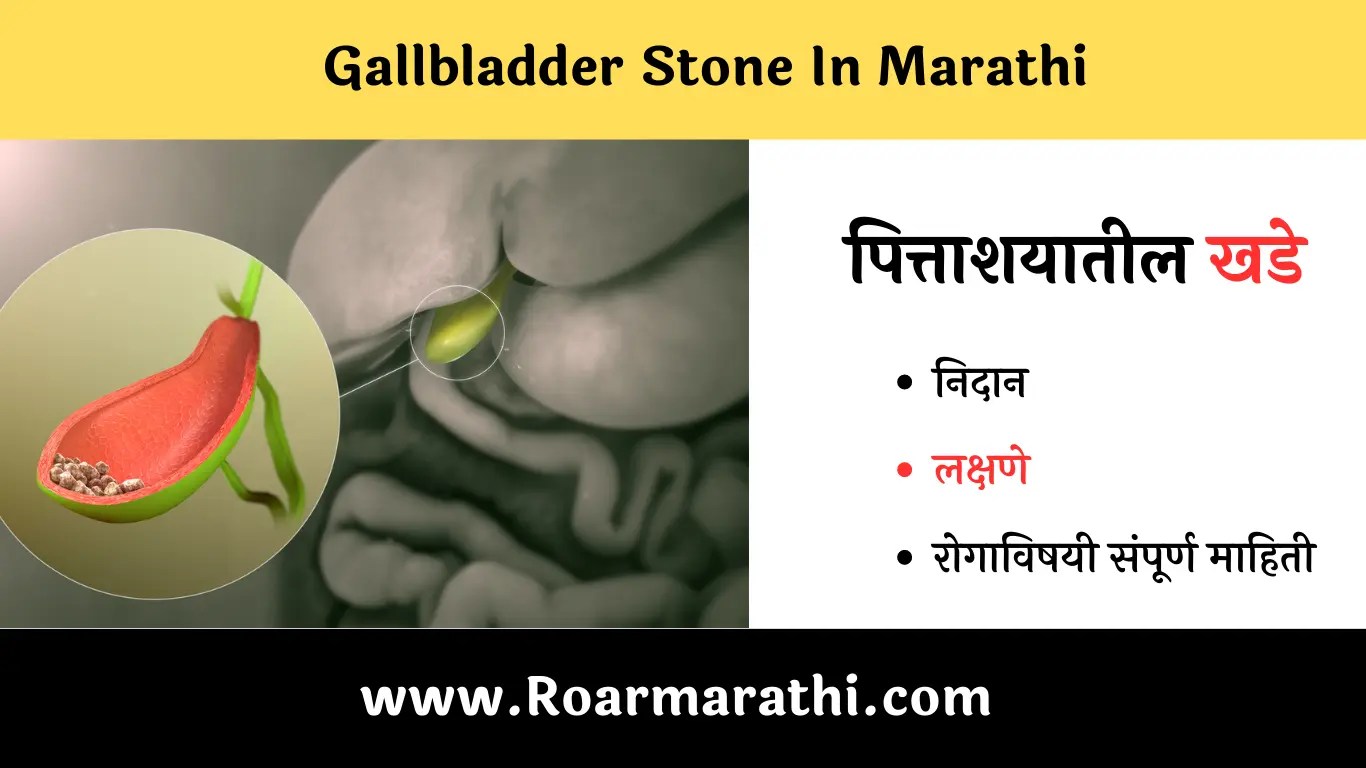Gallbladder Stone In Marathi पित्ताशयातील खडेची माहिती Roar Marathi