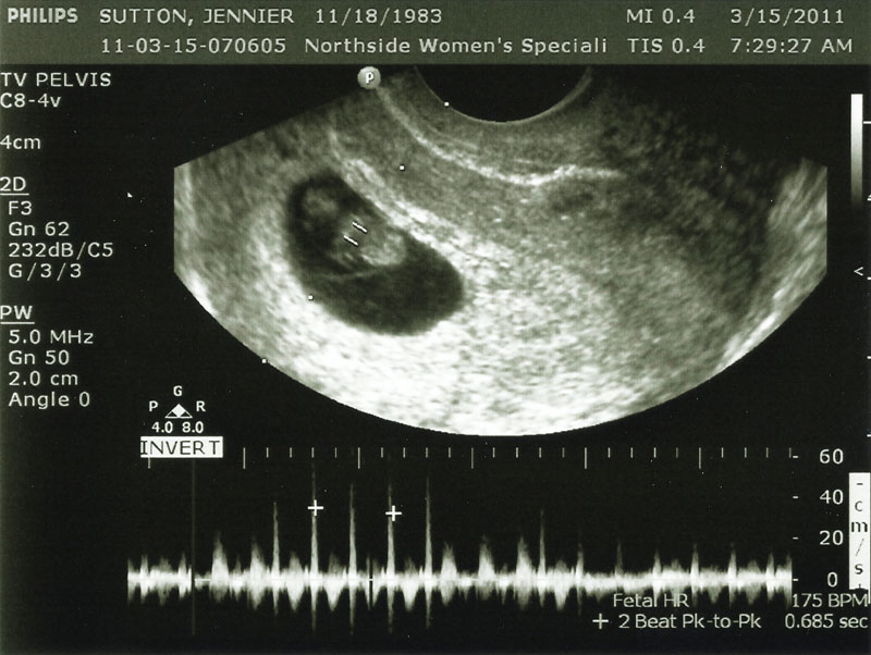 8 Week Ultrasound The Moment Of Truth Robb Sutton