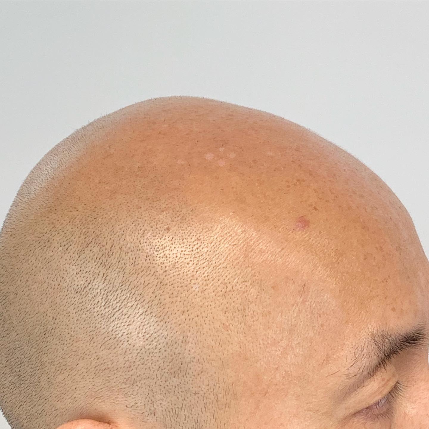 How To Prevent A Shiny Scalp Before And After Smp -