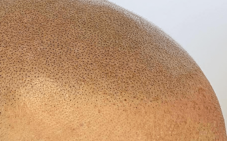 SMP Archives Vancouver Scalp Micropigmentation Vancouver SMP
