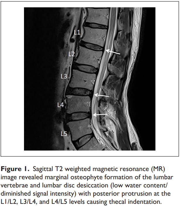 Taming of the Testicular Pain Complicating Lumbar Disc Herniation With