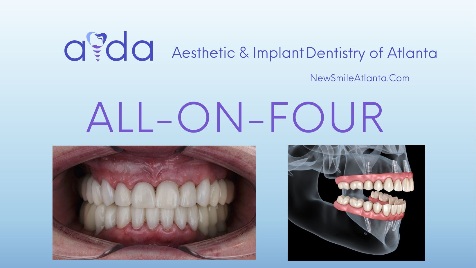 Aesthetic & Implant Dentistry of Atlanta Rolling Out