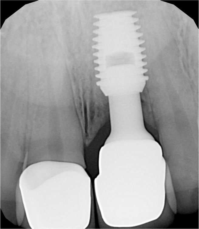 Dental Implant Center Roma impianto su incisivo superiore fratturato Dental Implant Center Roma