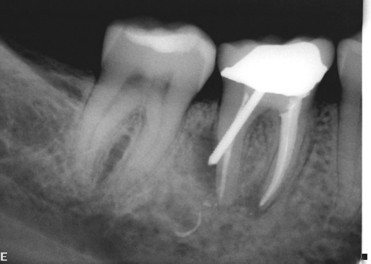 Aventura Endodontic Group, LLC Case Reports in Aventura