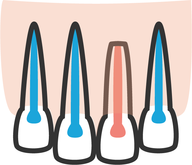 Apexification Root Canal Specialty Associates