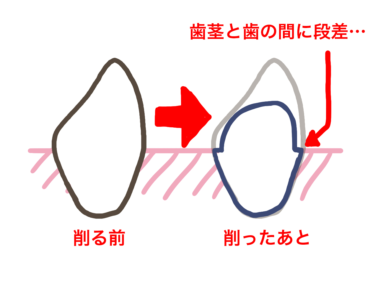 保険適用で安い値段だったので白い歯を入れてみた ラフのラフ？