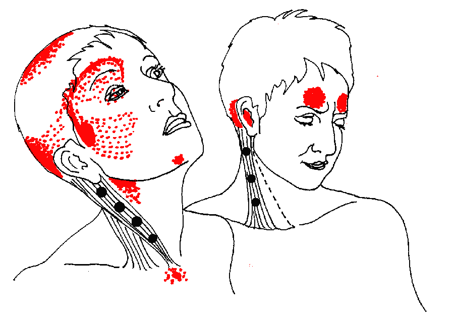 Common and rare diseases in head & neck Pain in Head & Neck