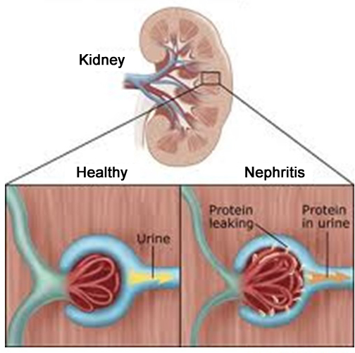 Nephritis to Dr. Amina's Royal Ayurveda™