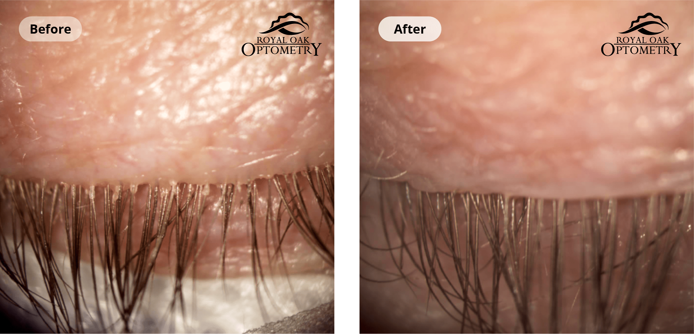 Two images of the same eye before and after ZEST treatment. Royal Oak