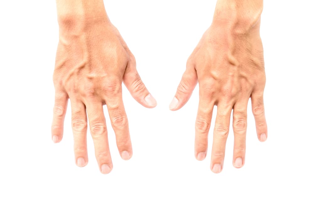 Sclerotherapy A Treatment for Hand Veins Shaheen Vascular