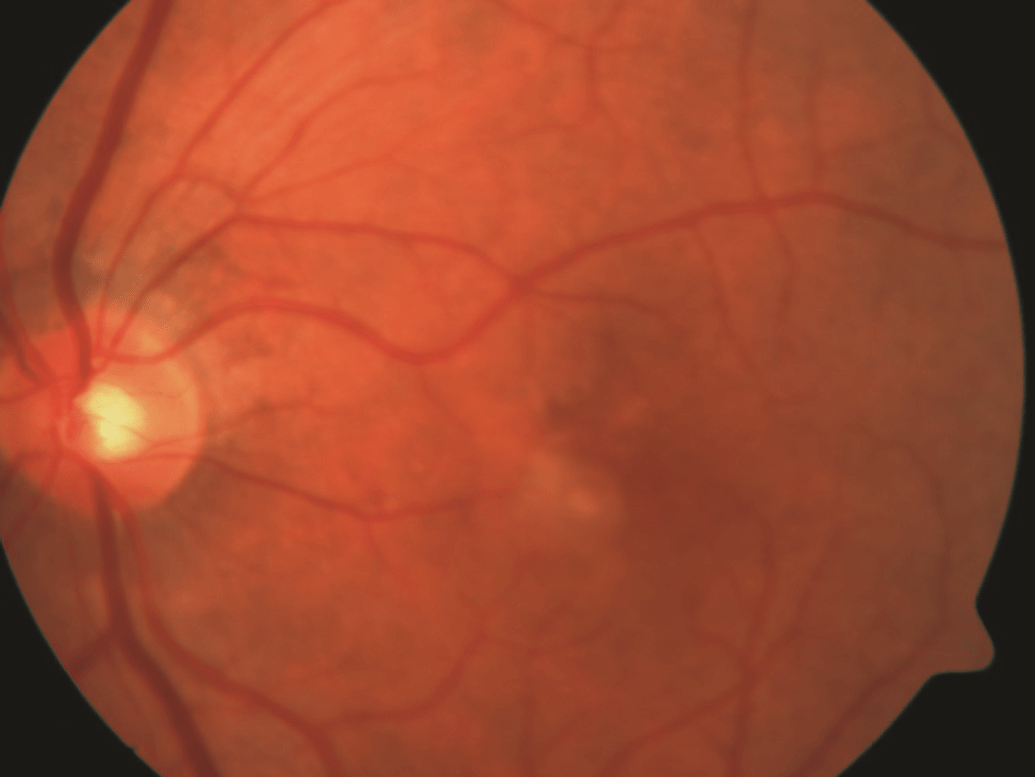 AgeRelated Macular Degeneration Retina Specialists of North Alabama, LLC
