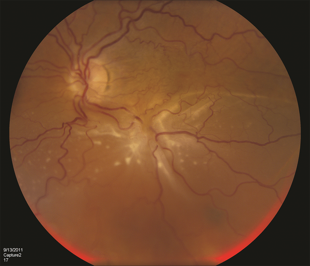 Complex Retinal Detachment Retina Specialists of North Alabama, LLC