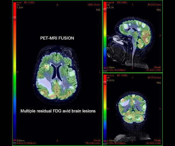 Best Digital PETCT Scan in Pune, India Ruby Hall Clinic