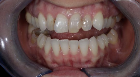 Composite Bonding Ruh Dental