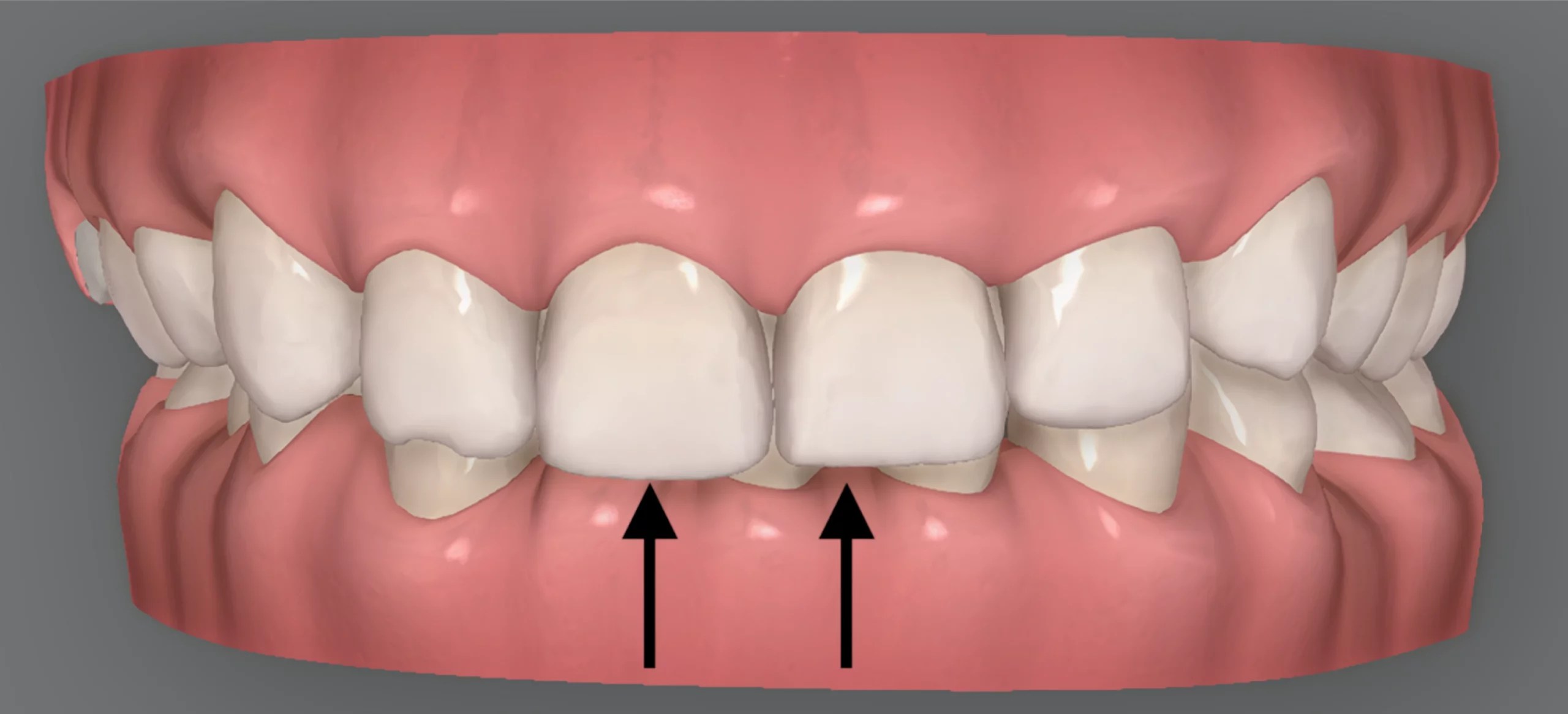 Can Invisalign fix an overbite? Ruh Dental Ruh Dental