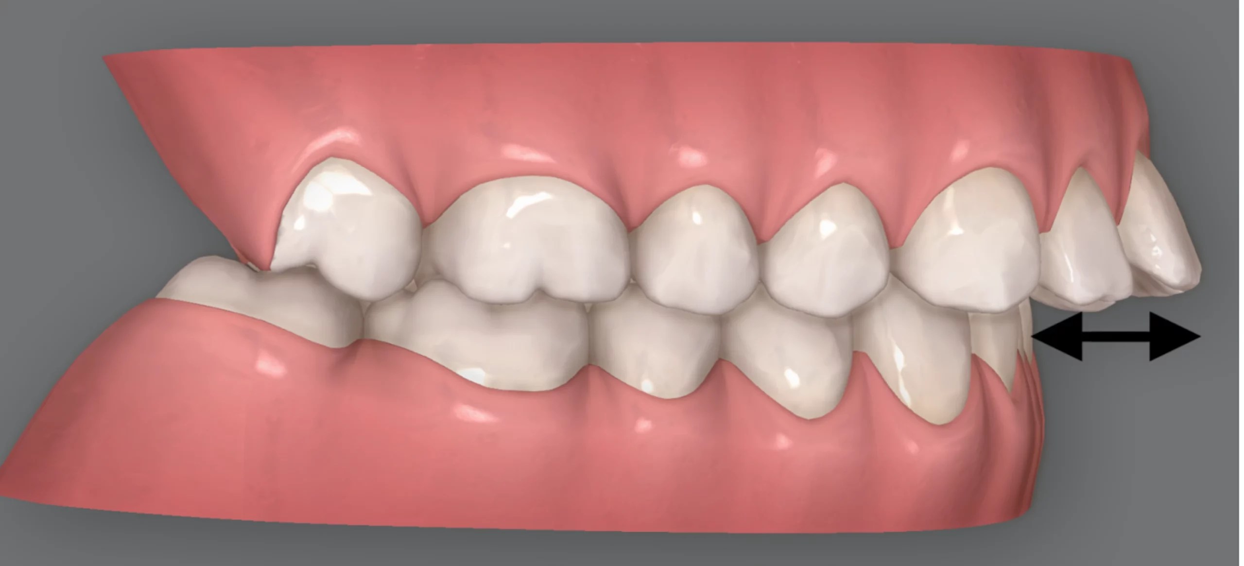 Can Invisalign fix an overbite? Ruh Dental Ruh Dental