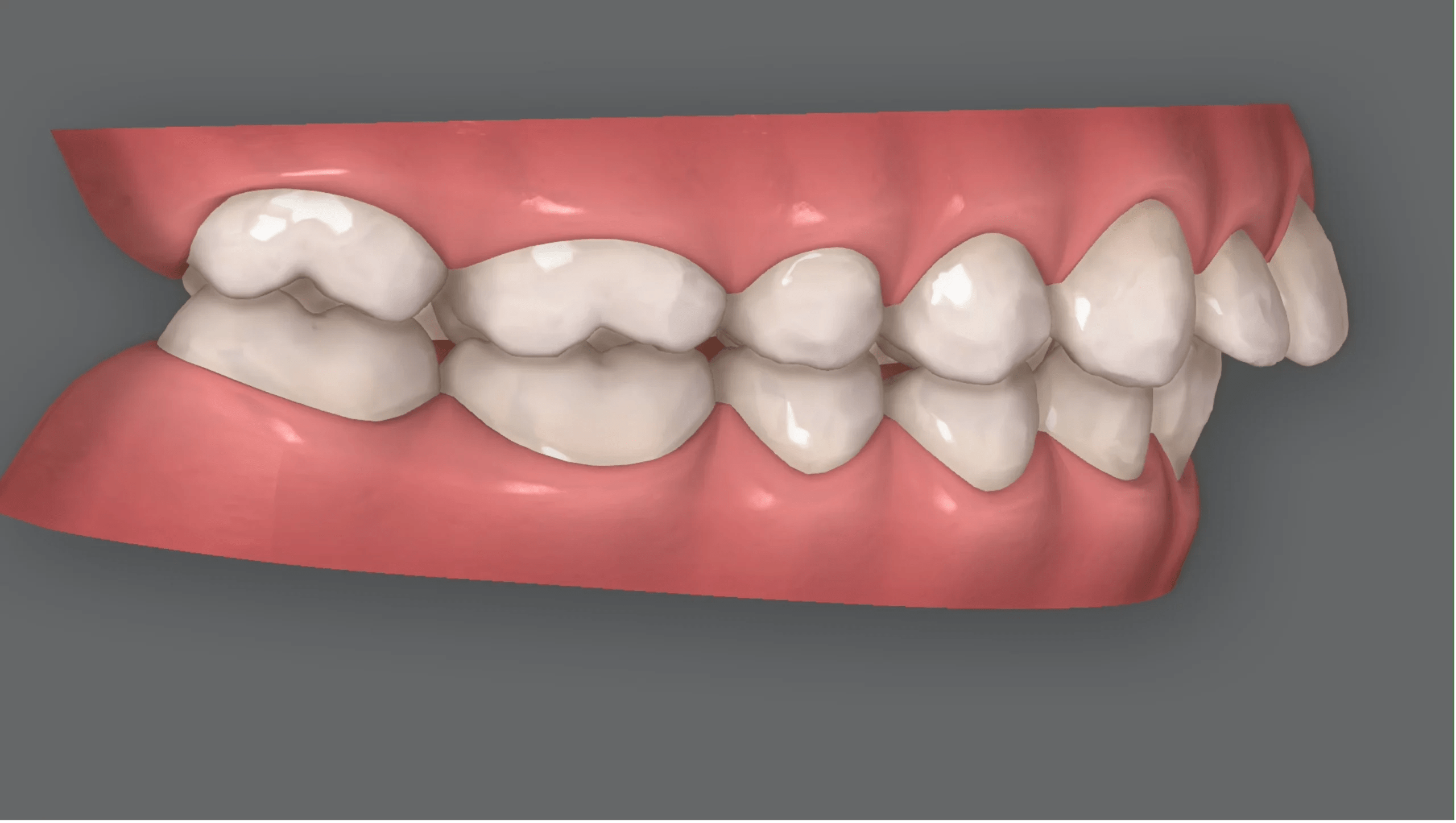 Can Invisalign fix an overbite? Ruh Dental Ruh Dental