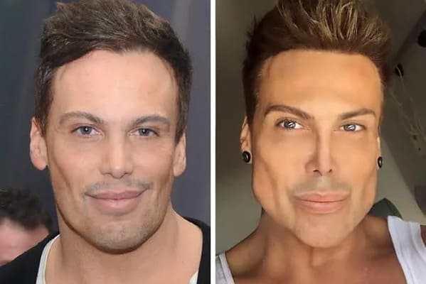 People In The "Botched Surgeries" Reddit Share Pictures Of Their