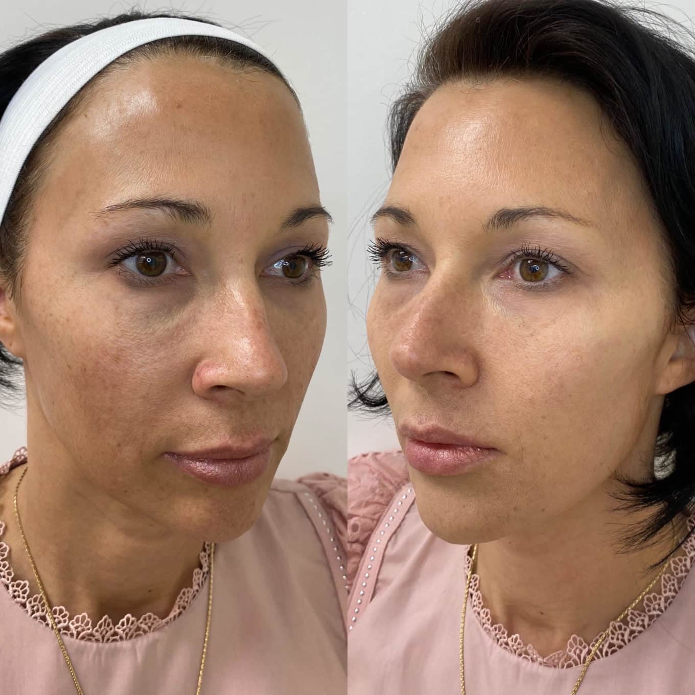 PDO Threading Lowrisk Lifting and Defining RUMA Aesthetics