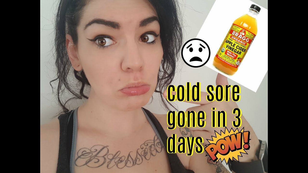 Apple cider vinegar cold sore quick relief remedies