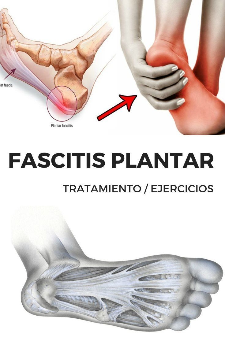 FASCITIS PLANTAR TRATAMIENTO 9 Trucos para curar la FASCITIS PLANTAR