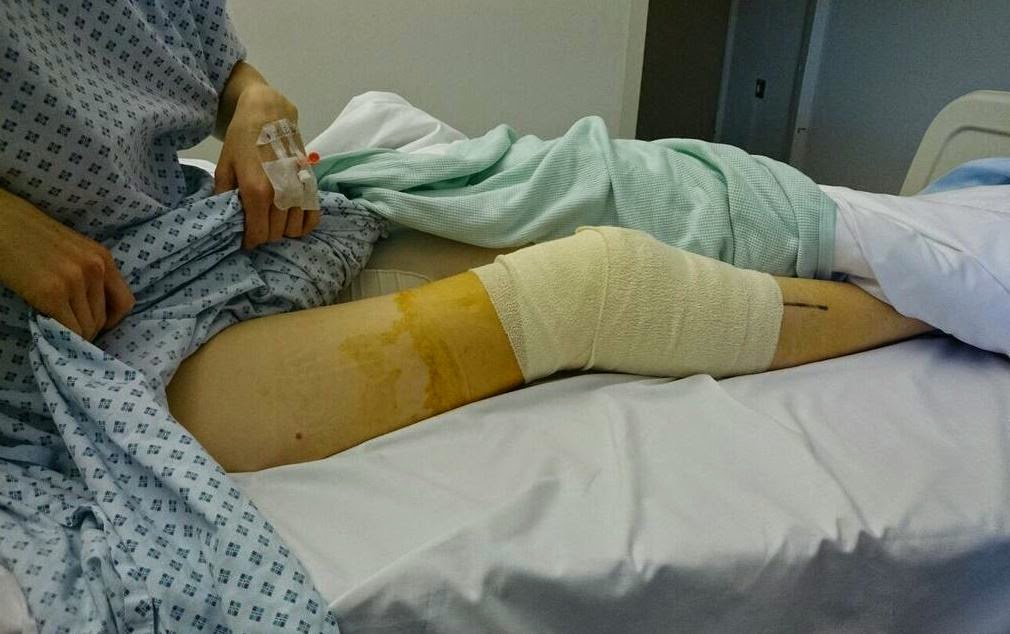 2 Babies....2 Knee Operations Run Jump Scrap!